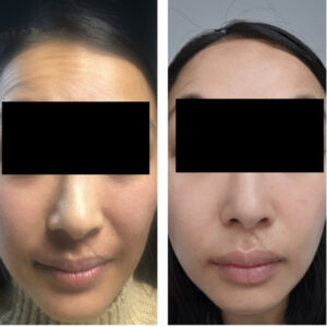 Anti Wrinkle Treatment Before And After Dr Kate Aesthetics London