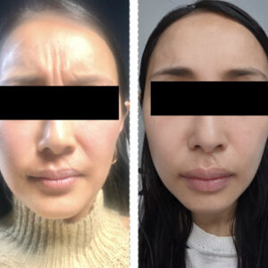 Anti Wrinkle Treatment Before And After Dr Kate Aesthetics London