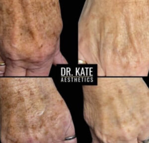 Lumecca 1 - Dr Kate Aesthetics