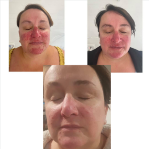 WOW Facial Fusion Before Afters Dr Kate Aesthetics