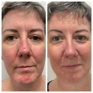 WOW Facial Fusion Before Afters Dr Kate Aesthetics