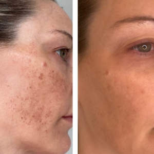 Lumecca Before And After Dr Kate Aesthetics