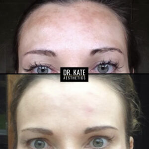 Pigmentation Before And After Skin Treatment