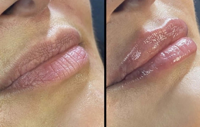 Before And Afters: Lip Fillers