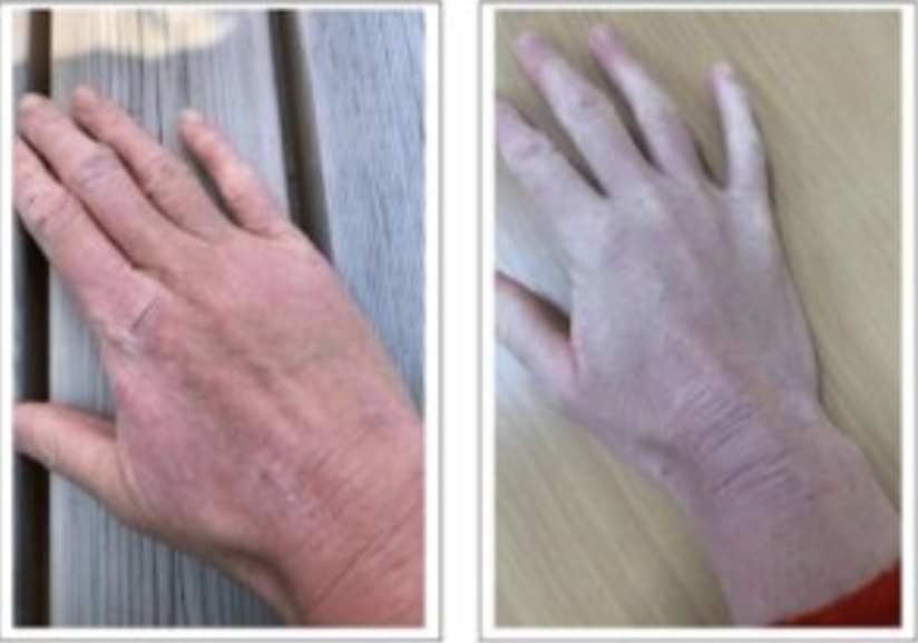 Exploring Cold Atmospheric Plasma Therapy for Topical Steroid Withdrawal (TSW): A Breakthrough Skin Recovery Solution