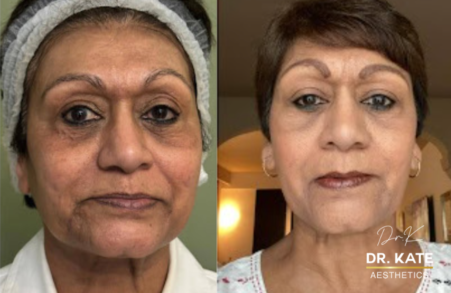 LipoLas® Laser Treatment: A New Approach to Fat Reduction and Skin Tightening