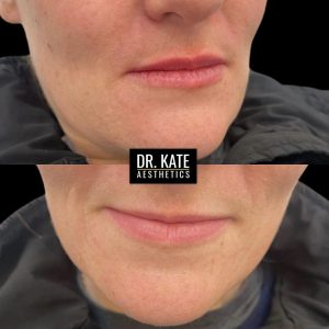 Dr Kate Aesthetics Cockfosters Enfield London Lip Fillers Clinic