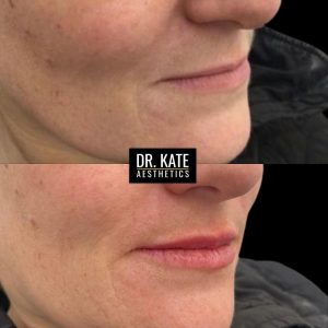Dr Kate Aesthetics Cockfosters Enfield London Lip Fillers Clinic