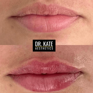 Lip Fillers London Dr Kate Aesthetics Clinic Cockfosters Enfield