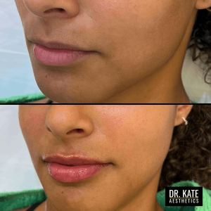 Lip Fillers London Dr Kate Aesthetics Clinic Cockfosters Enfield 2