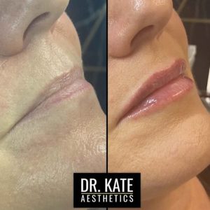 Lips Fillers Dr Kate Aesthetics London