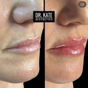 Lips Fillers Dr Kate Aesthetics London