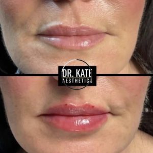 Lips Fillers Dr Kate Aesthetics London