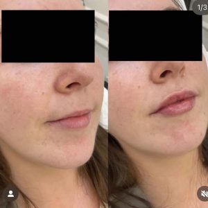 Lips Fillers Dr Kate Aesthetics London