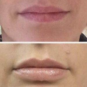 Lips Fillers Dr Kate Aesthetics London