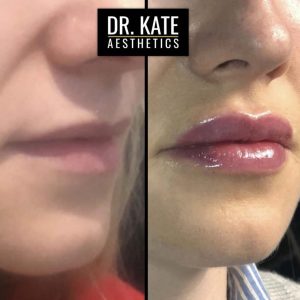 Lips Fillers Dr Kate Aesthetics London