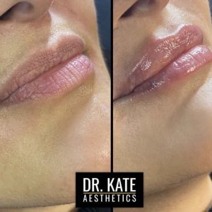 Lips Fillers Dr Kate Aesthetics London