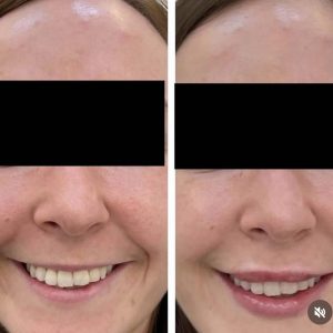Lips Fillers Dr Kate Aesthetics London